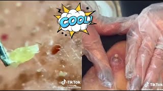 Ultimate Satisfying Acne Removal Compilation Best Pimple Pops Blackheads and Cysts [upl. by Curnin817]