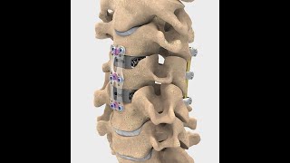 Spine Approaches 4 Anterior Approaches to SubAxial Cervical Spine [upl. by Anahsek]