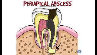 Periapical Abscess [upl. by Willy]