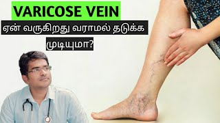 Varicose vein causesamptreatment in tamilmedical awareness in tamil [upl. by Silvester]