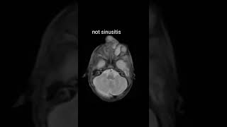 Encephalocele radiology medical radiologylife encephalocele mri pediatrics neuroimaging [upl. by Yuu]