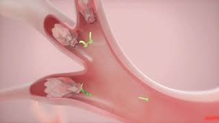 How It Works Zephyr Valve Treatment for COPD amp Emphysema [upl. by Jacobine414]