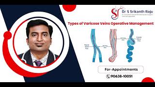 Varicose Veins Operative Management Types  DrSrikanth Raju  Vascular Surgeon  Hyderabad [upl. by Gewirtz]