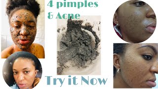 Remove Pimples and Black Spot With Black seed Powder Over Night Pimples Treatment [upl. by Ynneh]