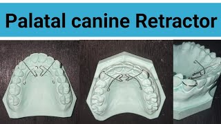 palatal canine Retractor  Canine Retractor  Easy step of Palatal canine Retractor  Orthodontist [upl. by Eimiaj555]