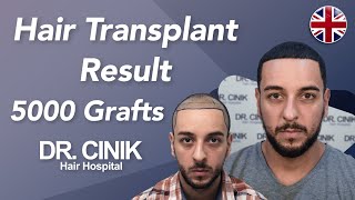 Hair Transplant Results with 5000 Grafts  Before and After  Dr Emrah Cinik [upl. by Ardnwahsal]