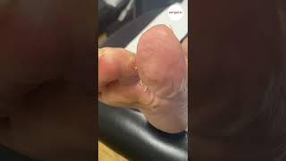 Hard skin forms between toes debrided by podiatrist [upl. by Yart]