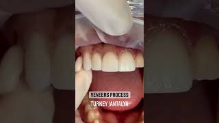 From the UK to Turkey Dental Veneers Transformation at Dentatur dentatur smiledesignturkey [upl. by Eigla]