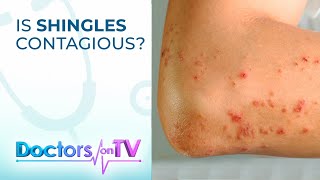 Shingles Cause Symptoms amp Prevention  DOTV [upl. by Minton22]