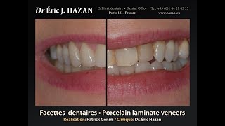 Facettes dentaires  Porcelain laminate veneers Paris France [upl. by Aral]