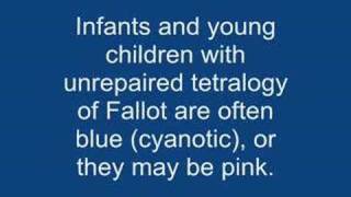 Tetralogy of fallot TOF [upl. by Dnomse]