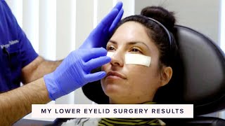 Real Lower Blepharoplasty Recovery amp Results  In the OR Part 3 of 3 [upl. by Esined883]