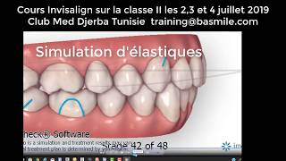 Invisalign et classe II  Les 4 solutions Invisalign [upl. by Adur367]