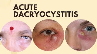 Acute Dacryocystitis [upl. by Lytsirhc707]