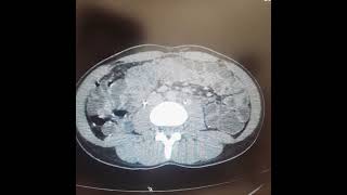 Ct Enterography with IV contrast [upl. by Yelekalb798]