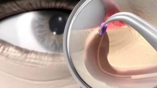 Punctum plug procedure  animation [upl. by Aniratac]