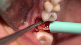 Ext Implant and Bone Graft with Complication [upl. by Laven235]