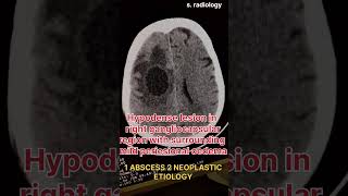 NEOPLASTIC ETIOLOGY CT BRAIN [upl. by Onirefez]