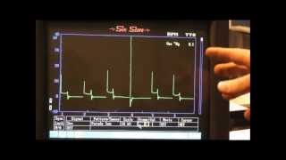 Secondary Ignition Waveforms common faults [upl. by Htebi539]