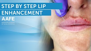 Lip Filler Tutorial  Post Care Procedure [upl. by Kunin]