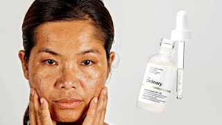 How To Use The Ordinary Alpha Arbutin 2  HA for Hyperpigmentation [upl. by Einna387]