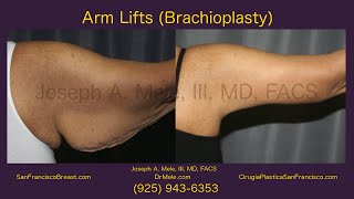 Arm Reduction Brachioplasty amp Arm Lifts SF Bay Area  08 [upl. by Brote]