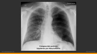 Patrones Pulmonares en la Radiografía de Tórax [upl. by Ravahs621]