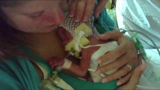 Premature Babies  One Born Every Minute [upl. by Vaenfila]