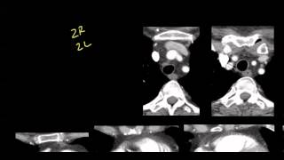 Mediastinal anatomy and nodal stations on CT [upl. by Ymmat]