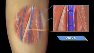 VenaCure EVLT Patient Video [upl. by Koal]