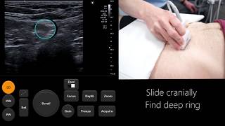 Ultrasound Tutorial InguinalFemoral Hernia Assessment  Radiology Nation [upl. by Onaivlis293]