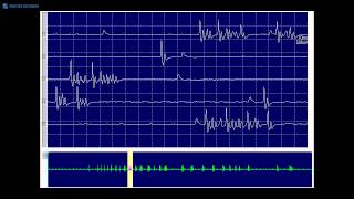 Kimura amp Kohara F34 Typical myokymic discharge seen in a demyelinating neuropathy [upl. by Beacham]