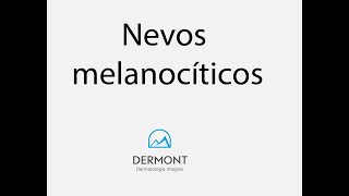 Nevos melanocíticos [upl. by Shapiro]