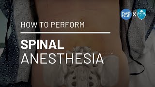 How to Perform Spinal Anesthesia [upl. by Toogood553]