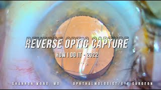 Reverse optic capture to treat Negative dysphotopsia How I do it 2022 [upl. by Mallory907]