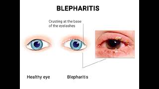 Blepharitis Definition of blepharitis Causes of blepharitis✨ [upl. by Eliades]