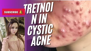 Use of isotretinoin in cystic acne [upl. by Howes]