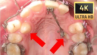 🤔 Journey to PERFECT SMILE😊 Before and After of Rare Transpositions in 4K [upl. by Einahteb]