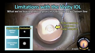 CataractCoach 1643 limitations with the Vivity IOL extended depth of focus [upl. by Bessy]