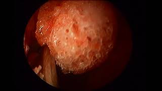 Right prelacrimal approach with septal correction unedited [upl. by Roe]