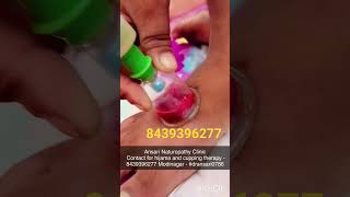 Hijama therapy for skin desease Eczema skin problem eczema treatment youtubeshorts shortvideo [upl. by Towney693]