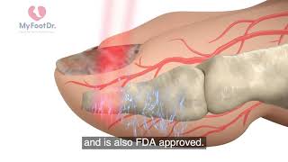 Lunula Laser Treatment with My FootDr Singapore  English subtitles [upl. by Lerrej784]