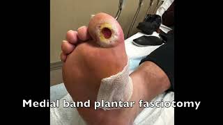 Medial Band Fasciotomy To Treat a Hallux Wound [upl. by Karon355]