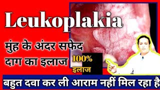 Dr Amit k Dubey । मुंह के अंदर सफेद दाग का इलाज  leukoplakia 100ठिक होगा। white patches in mouth [upl. by Nahallac]