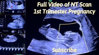 Baby Girl’s Ultrasound FULL VIDEO NT Scan I 1st Trimester II 12 Weeks Pregnant [upl. by Fransen473]