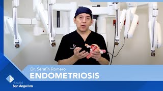 Endometriosis l Dr Serafín Romero [upl. by Enaitsirk]