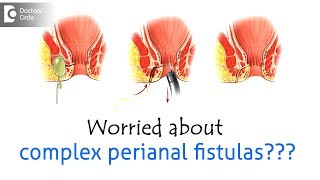 What is the treatment complex perianal fistulas  Dr Rajasekhar M R [upl. by Ettellocin]