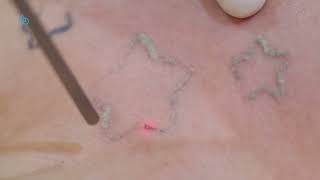 Advanced Tattoo Removal with FOTONA QSwitched Laser  AOKLINIK Penang [upl. by Diamante383]