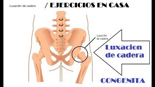 Luxación congénita de cadera  Terapia en casa [upl. by Aneert]