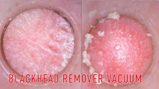 Closeup Blackhead Remover Pore Vacuum Cleaner Review Shorts [upl. by Anirod354]